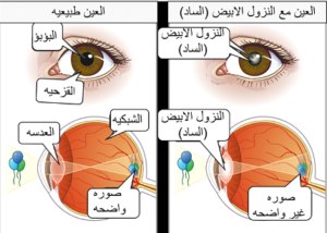 الساد الابيض عند الأطفال